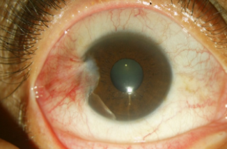 A 2–3 mm temporal pterygium without involvement of the papillary.