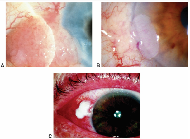 Conjunctival intraepithelial
 neoplasia. A. Papilliform. B. Gelatinous. C. Leukoplakic
 Conjunctival and corneal intraepithelial tumor (CIN)