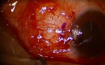Immediate postoperative photograph showing a suture conjunctival autograft after pterygium
 excision.