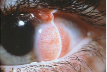 Limbal dermoid