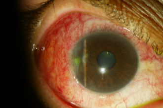 One week after surgery of the pterygium and placement of temporal conjunctival autograft.