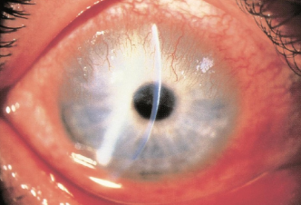 Pannus Episcleritis, sclerokeratitis